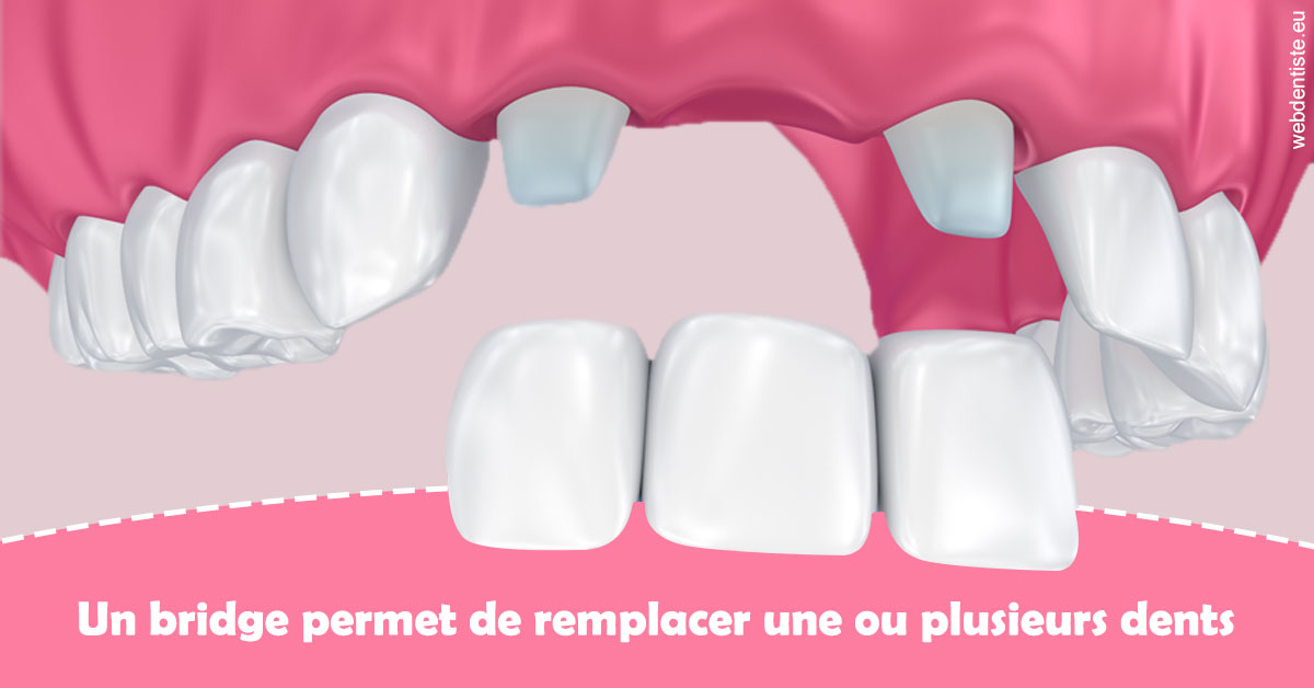 https://www.dr-weiss-sarfati.fr/Bridge remplacer dents 2