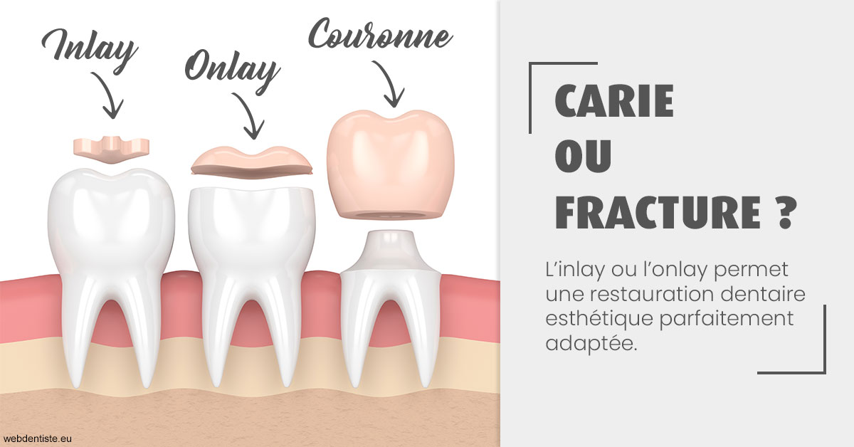 https://www.dr-weiss-sarfati.fr/T2 2023 - Carie ou fracture 1
