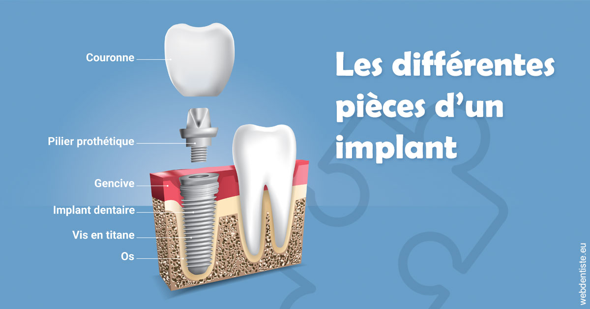 https://www.dr-weiss-sarfati.fr/Les différentes pièces d’un implant 1