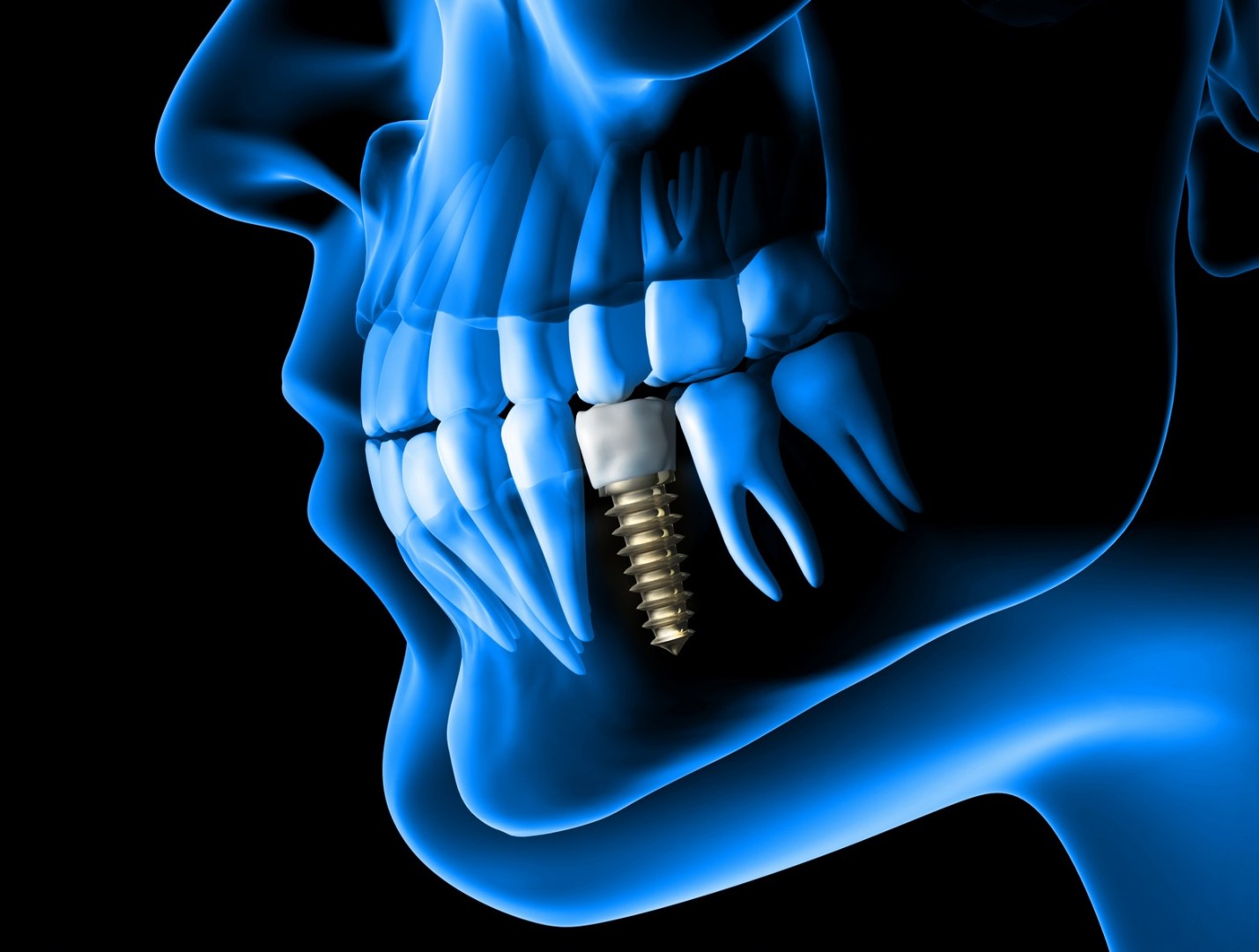 Schéma d'implant dentaire